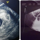 10th Weeks Pregnant Ultrasound